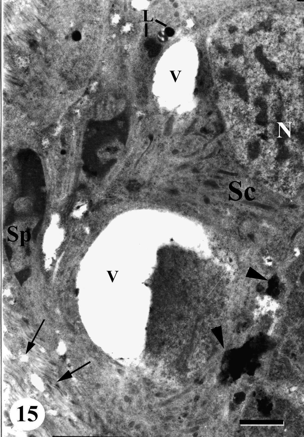 TEM of testis of adult male Schistosoma mansoni recovered from mice treated with Sidr honey and black-seed oil showing degenerated spermatocyte (Sc) with abnormally vacuolated cytoplasm (V), nucleus (N), lipid granules (L), aggregation of dark material in cytoplasm (arrowheads). Note degenerated follicular wall and circular muscles (arrow) and some regressed spermatozoa (Sp). Bar = 1 μm.