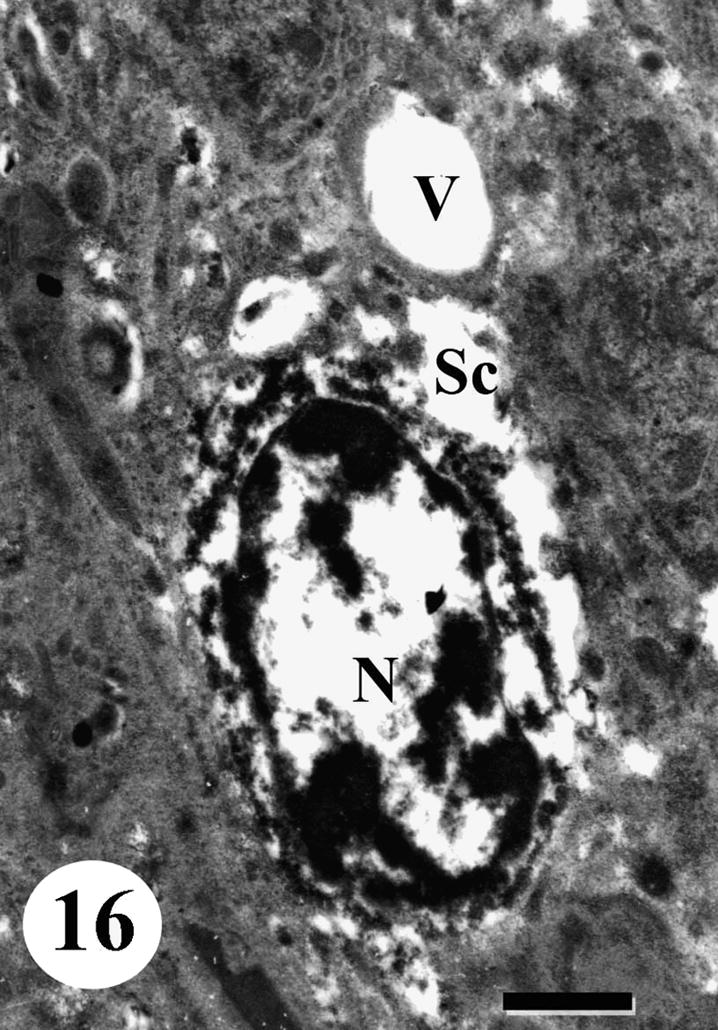 TEM of testis of adult male Schistosoma mansoni recovered from mice treated with Sidr honey and black-seed oil showing another degenerated spermatocyte (Sc) with vacuolated cytoplasm (V). Note seriously degenerated nucleus (N). Bar = 1 μm.