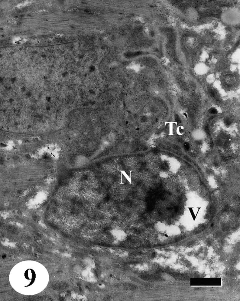 TEM of the tegumental cell of adult male Schistosoma mansoni recovered from infected mice treated with Sidr honey and black-seed oil showing distortion of the tegumental cells (Tc). Nucleus (N) with vacuolated nucleoplasm (V), secretory granules disappeared completely. Bar = 1 μm.