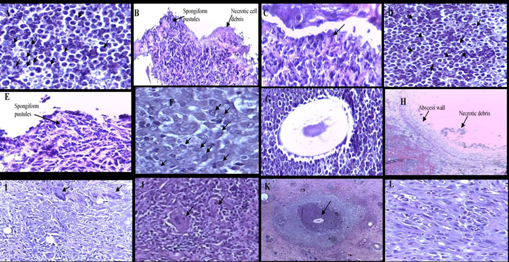 Histological features of the skin tissues infected with S. aureus (A, B and C), S. pyogenes (D, E and F), M. gypsum (G, H and I), C. albicans (J, K and L) show a longitudinal and cross-sections of skin tissues of localised infection at the injection site in the reticular dermis. (H&E, × 4). The arrows in A shows neutrophils, B shows spongiform pustules containing numerous neutrophils, C shows a cross-section of subcorneal pustule containing numerous neutrophils, D show neutrophils, E shows a cross-section of spongiform pustules which contain numerous neutrophils, F shows macrophages, G shows hair follicle surrounded with neutrophils, H shows abscess wall and necrotic debris, I shows numerous inflammatory cells including neutrophils, macrophages and giant cells, J arrows represent giant cells, K shows granuloma formation, L shows numerous inflammatory cells including neutrophils, macrophages and giant cells.