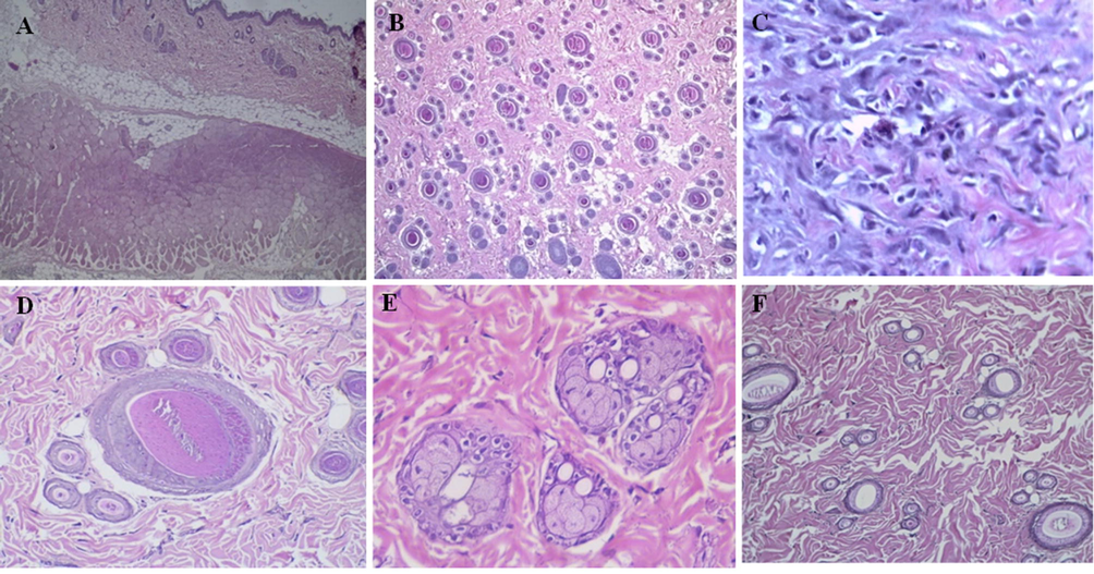 (A) shows a cross-section of untreated cell skin layers with normal appearance (H&E, × 4), (B) shows a longitudinal section of untreated cell skin tissues (H&E, × 4), (C) shows fibroblasts and fibrosis formation (H&E, × 4), (D) shows normal hair follicles (H&E, × 40), (E) shows thick collagen bundles and normal sebaceous glands (H&E, × 40) and (F) shows infection recovery by collagen fibres formation, and there is no inflammation was identified (H&E, × 20).