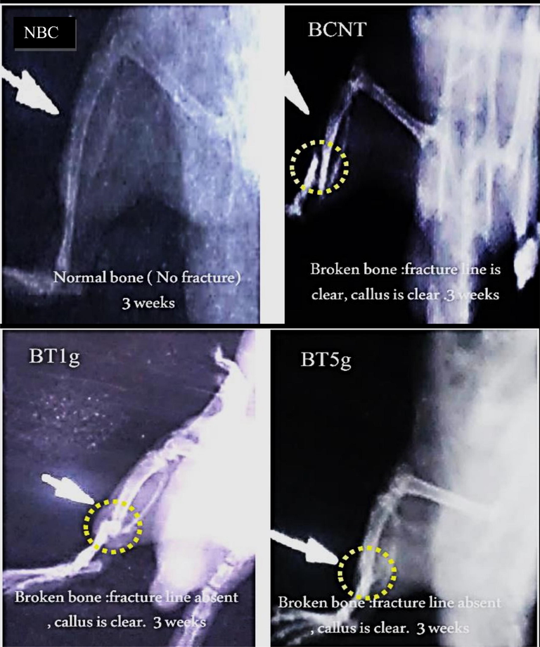 X-ray photos after three weeks of tibial fracture induced in male albino rats. NBC = Non-Broken control; BCNT = Broken control-non treated; BT1g = Broken- treated with1g. BT5g = Broken- treated with 5 g; Yellow circle = the zone of induced fracture; White arrow indicate the fracture line.