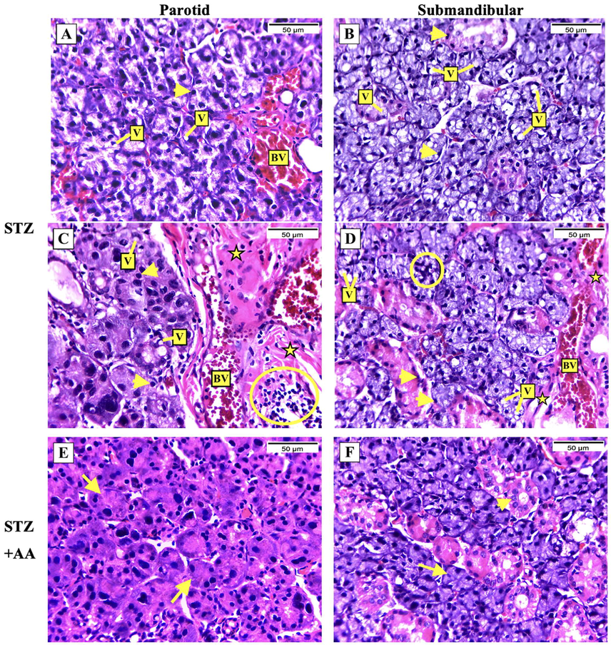 Representative photographs of salivary glands’ histology; H&E-stained, magnification X400. [A & C] parotid of the STZ group, [B & D] submandibular gland of the STZ group showing irregular acini, vacuolated cytoplasm (V) of cells lining serous acini and ducts, pyknotic nuclei (arrowheads), thickened connective tissue septa (stars), leukocytic infiltration (circle), and congested vessels (B.V). [E & F] parotid and submandibular glands of the STZ + AA group, respectively, showing the acini (arrows) and ducts (arrowheads) mostly restored the normal architecture with regular epithelial lining.