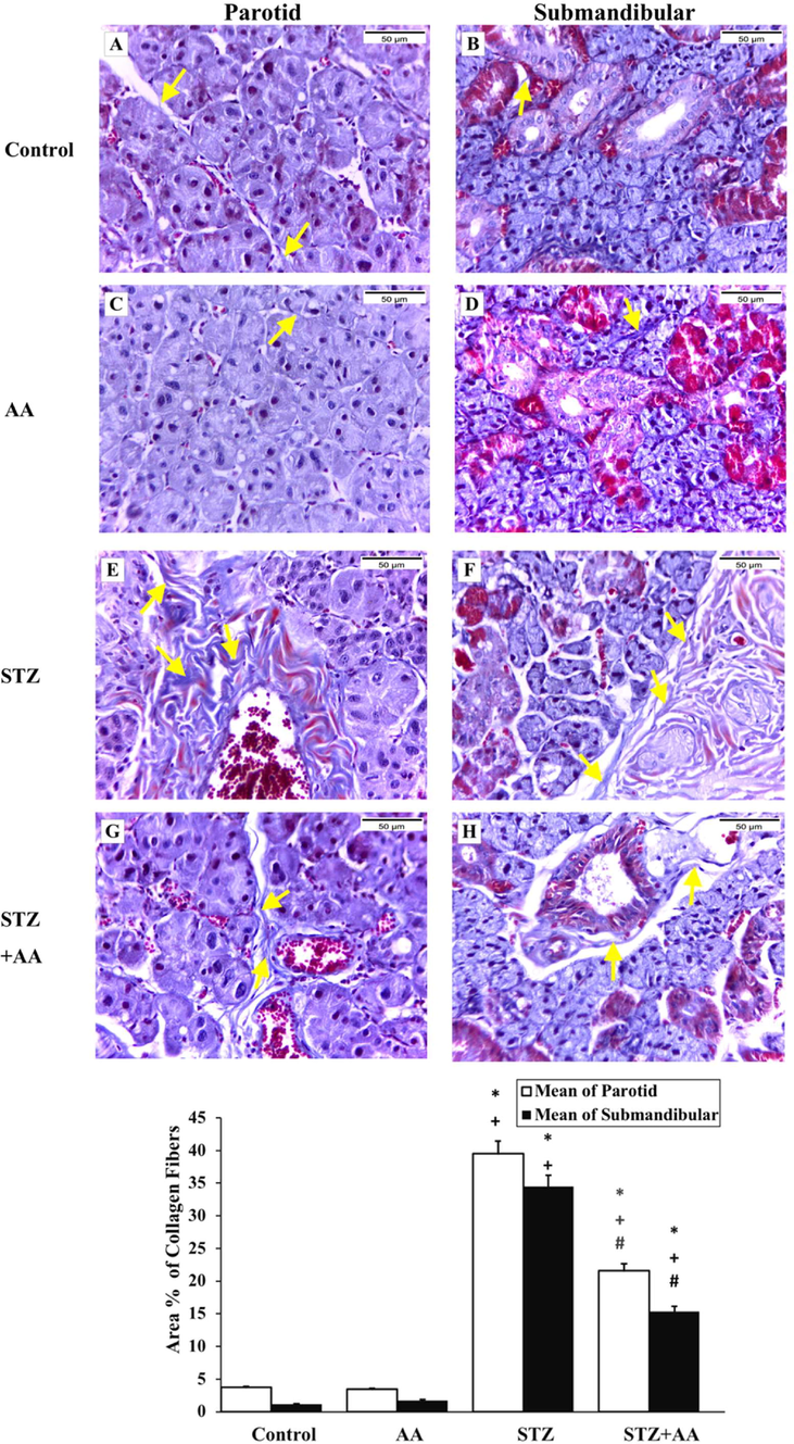 Masson’s trichrome staining in salivary glands, magnification X 400. [A & C] parotid of the control and AA groups, respectively, [B & D] submandibular gland of control and AA groups, respectively, showing mild collagen staining (arrows). [E & F] Parotid and submandibular glands of STZ group, respectively, showing marked increased collagen staining (arrows). [G & H] parotid and submandibular gland of STZ + AA group, respectively, showing moderate collagen staining (arrows). * significant from control, + significant from AA group, # significant from STZ group at p ≤ 0.05.