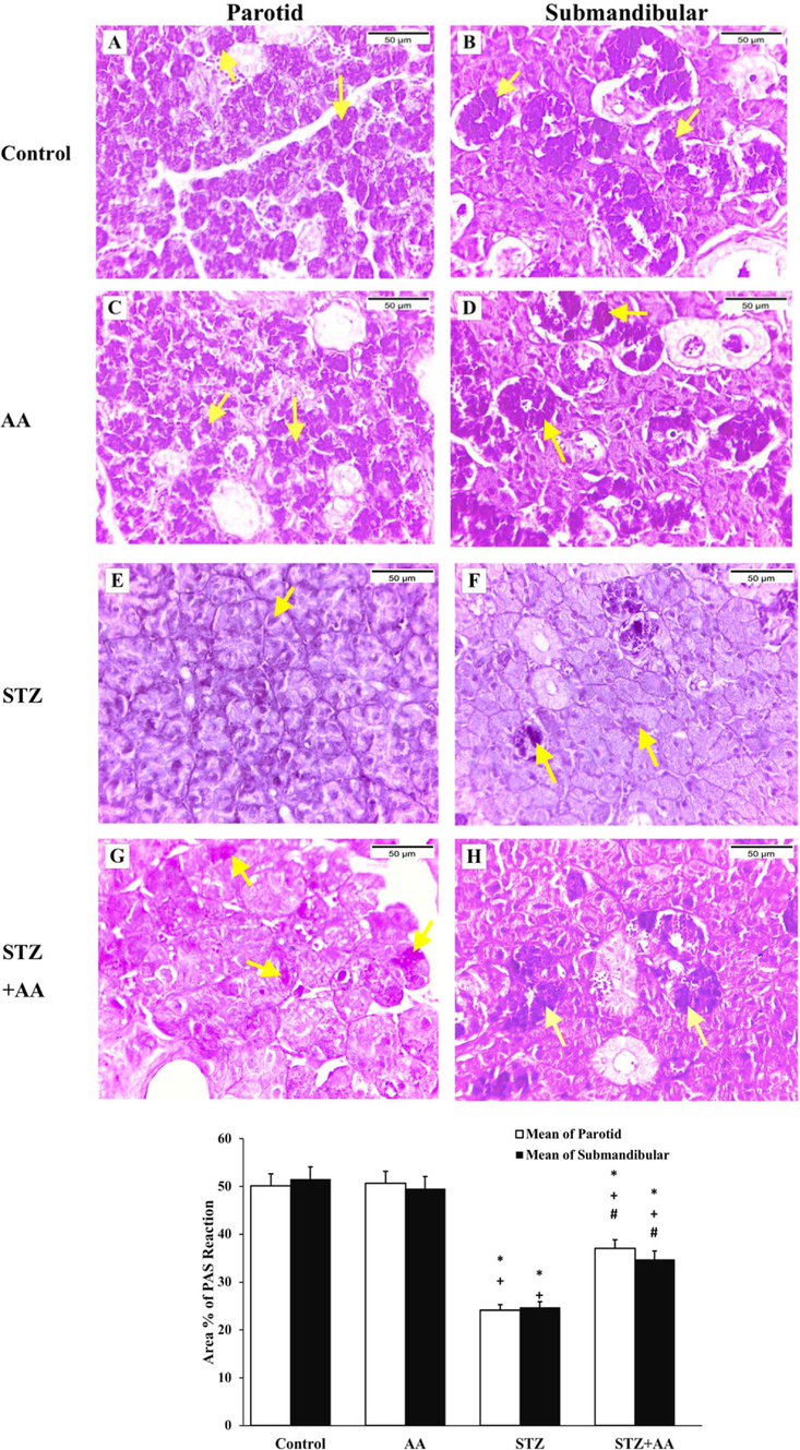 PAS staining in salivary glands, magnification X 400. [A & C] parotid of the control and AA groups, respectively, [B & D] submandibular gland of the control and AA groups, respectively, showing strong PAS reaction (arrows). [E & F] parotid and submandibular glands of the STZ group, respectively, showing weak PAS reaction (arrows). [G & H] parotid and submandibular glands of the STZ + AA group, respectively, showing moderate PAS reaction (arrows). * Significant from control, + Significant from AA group, # Significant from STZ group at p ≤ 0.05.