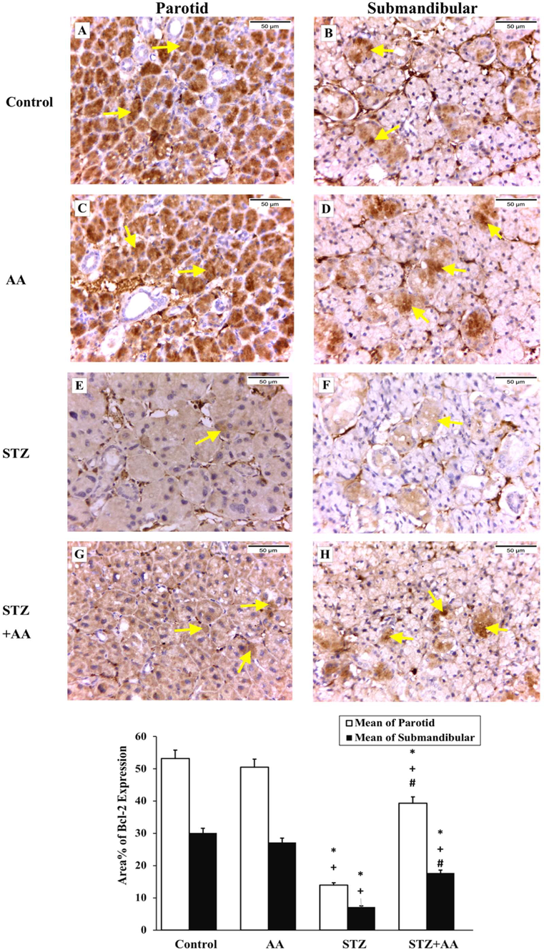 Immunohistochemical staining for Bcl-2 in salivary glands, magnification X 400. [A & C] parotid of control and AA groups, respectively, showing strong positive Bcl-2 expression in acinar cells (arrows). [B & D] submandibular gland of control and AA groups, respectively, showing strong positive cytoplasmic Bcl-2 expression in acinar and ductal cells (arrows). [E & F] parotid and submandibular glands of STZ group respectively showing weak cytoplasmic Bcl-2 expression (arrows). [G & H] parotid and submandibular glands of STZ + AA group respectively showing moderate positive Bcl-2 expression (arrows). * significant from control, + significant from AA group, # significant from STZ group at p ≤ 0.05.