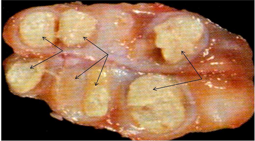 Affected lymph nodes filled with pus and caseated materials.