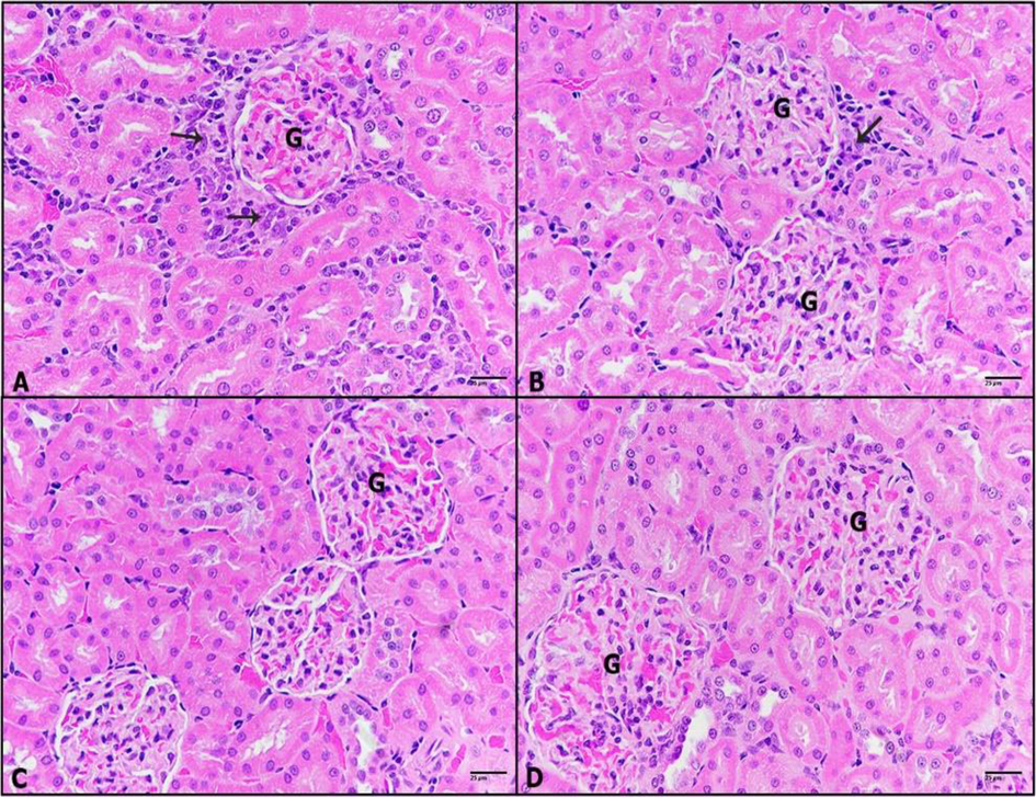 A-D: Photomicrographs of kidney sections of (A): DHM-treated rats showing carcinoma cells mixed with inflammatory cells (black arrow) surrounded glomeruli. (B): 0.25 mg/kg IVM plus DHM-treated rats displaying less incidence of carcinoma and inflammatory cells (black arrow). (C): 0.50 mg/kg IVM plus DHM-treated rats revealing healthy renal tissue. (D): 1 mg/kg IVM plus DHM-treated rats displaying healthy kidney tissue. Glomerulus (G), (H&E-400×).