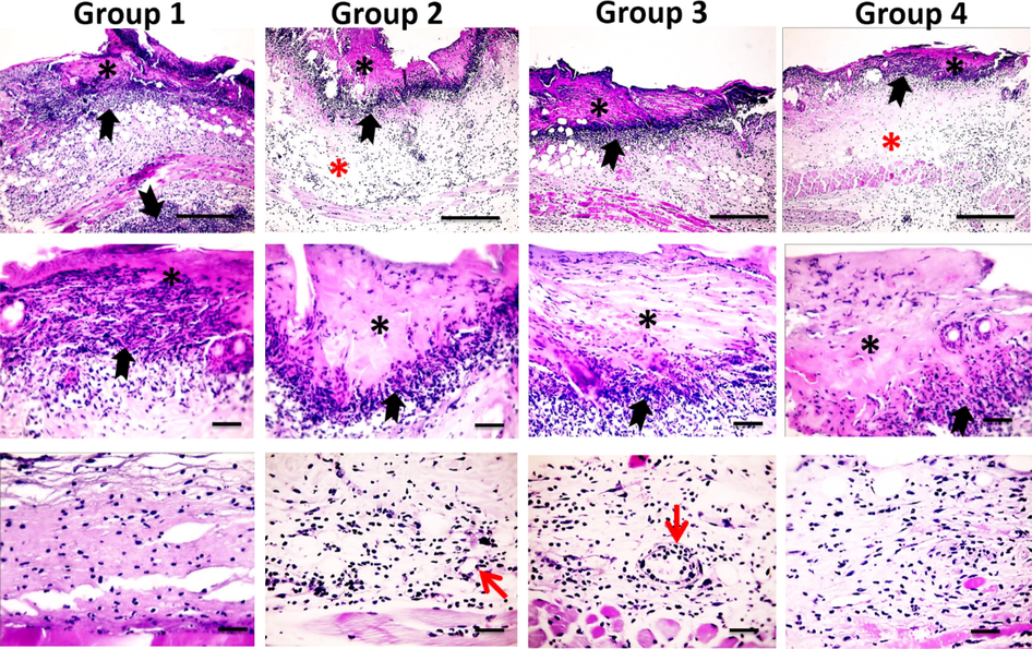 Microscopic pictures of H&E stained skin sections from four groups on the 3rd day after burn injury showing epiderma necrosis (*) with intense inflammatory reaction (black arrows) in all groups, stronger and deeper inflammation in Group 1, edema (*) in groups 2&4 (X: 100 bar 100 in 1st row). By higher magnification, the inflammatory reaction is mainly neutrophils infiltration (black arrows). Neovascularization (red arrows) appears in Groups 2&3 (X:400 bar 50 in 2nd and 3rd rows).