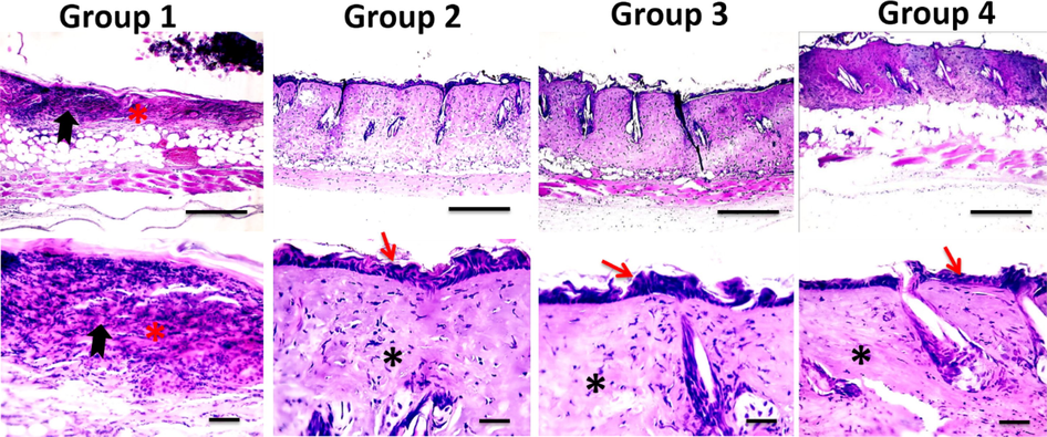 Microscopic pictures of H&E stained skin sections from four groups on the 7th day after burn injury showing the persistence of epidermal necrosis (*) with intense neutrophilic infiltration (black arrows) in Group 1 (X: 100 bar 100 in 1st row), re-epithelization (red arrows) and deposition of collagen (*) in treated groups 2–3 in higher magnification (X:400 bar 50 in 2nd and 3rd rows).