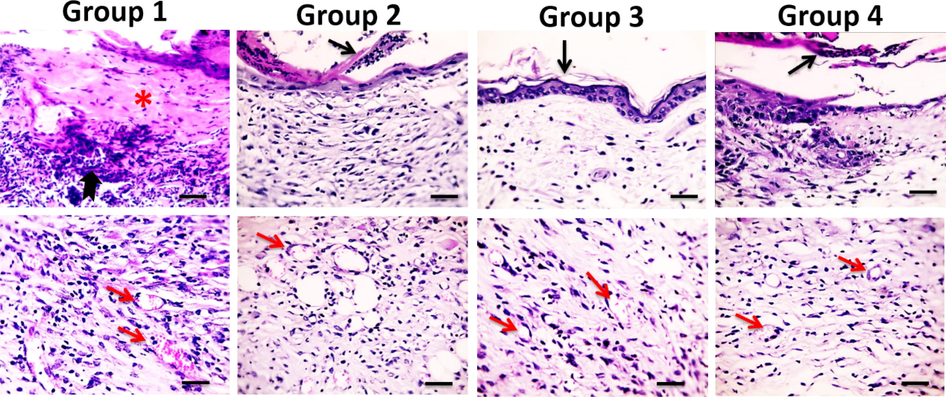 Microscopic pictures of H&E stained skin sections from four groups on the 14th day after burn injury showing the persistence of epidermal necrosis (*) with intense neutrophilic infiltration (black arrows) in Group 1, parakeratosis (black arrows) in Groups 2&4, orthokeratin in (black arrow) in Group 3, neovascularization (red arrows) in all groups (thick blue arrows) X:400 bar 50.