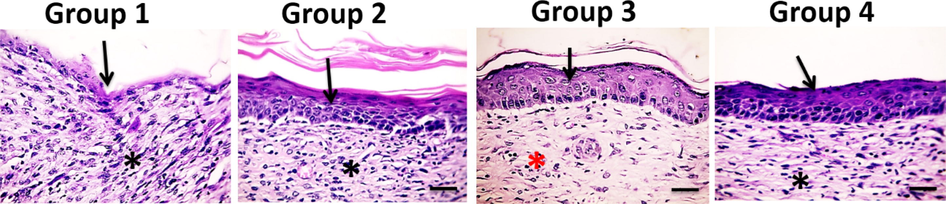 Microscopic pictures of H&E stained skin sections from four groups on the 21st day after burn injury showing few squamous epidermal cells in Group 1, completed new epithelization in Groups 2–4, inflamed granulation tissue in Groups 1, 2&4 (*), well-organized bands of collagen in Group 3 (*) X:400 bar 50.