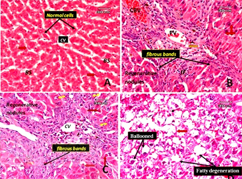 Photomicrographs of rat liver sections. A: Normal hepatic section with classic hepatic lobules containing central vein (CV) and separated by blood sinusoids (BS). The cords of hepatocytes are lined by flattened endothelial cells (arrowhead) and Kupffer cells (red arrow). B: A TAA-treated rat's liver section only shows cirrhotic nodules. Cirrhosis is characterized by fibrotic bands with loss of architecture and nodule formation. The bands intervene between the regenerative hepatocyte nodules, around the portal vein (PV), around congested blood vessels (CBV) and numerous small proliferated bile ducts (orange arrow). Hyperchomatic nuclei with clumping chromatin (red arrow) and a few inflammatory cells are present in fibrous tissue (IF). C: Liver section of rat treated with TAA only (another different filed from that of B) showing dense fibrous bands surrounded the central vein and around perisinusoidal spaces and eventually will progress to cirrhosis, some hepatocyte appeared apoptosis with cells shrinkage and chromatin margination (red arrow), some enlarged hepatocytes with karyomegaly and multiple nuclei are present (Yellow arrow). D: Liver section of rat treated with TAA only showing ballooning degeneration form of cell death, accumulation of fatty changes (steatosis) and blood sinusoids appeared narrow or obliterated (red arrow) (E&H).