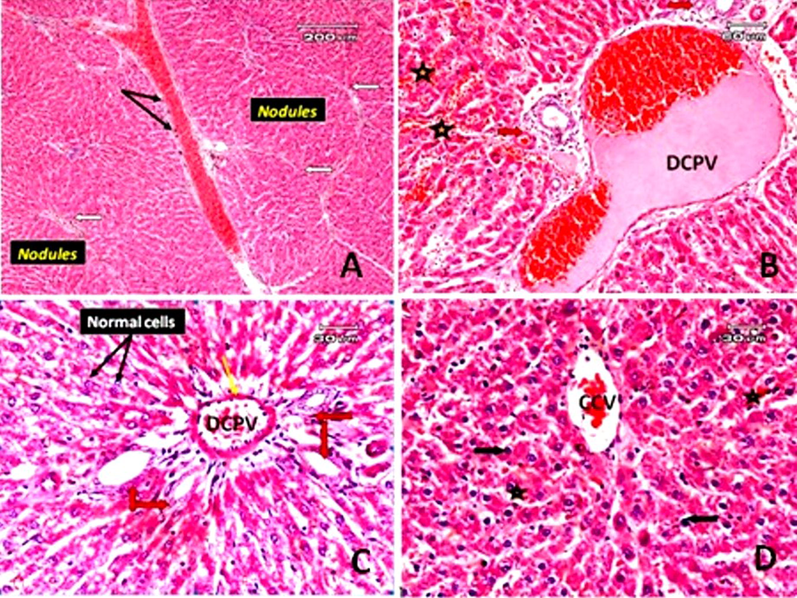 Photomicrographs of sections of rat liver. A: Liver section of a rat treated with TAA and subjected to gallic acid at a dose of 100 mg/kg (low dose) demonstrating micronodular liver cirrhosis, regenerative nodules separated by thin fibrous bands, fibrous bands (white arrow) surrounding the nodules and around the dilated congested blood vessels, and cellular infiltration around them (black arrow). B: Liver section of rat treated with TAA and subjected to gallic acid (low dose) (another filed from that of A) showing dilated congested portal vein (DCPV) and bile duct hyperplasia (red arrow), deposition of thin collagen fibers mixed with a few inflammatory cells in the portal area. Red blood vessels in dilated blood sinusoids could be observed (star). C: The liver section of a rat treated with TAA along with gallic acid at a dose level of 200 mg/kg (high dose), showed some hepatic cells that more or less appeared normal (black arrow), but mild dilated and congested portal vein (DCPV), a thickened portal vein vascular wall (yellow arrow) and hyperplasia of the bile duct (red arrow). D: A congested central vein (CCV) in a rat treated with TAA and gallic acid at a high dose (another field from that of C), some pyknotic hepatocytes (black arrow), and red blood cells in the blood sinusoidal space (star) (E&H).