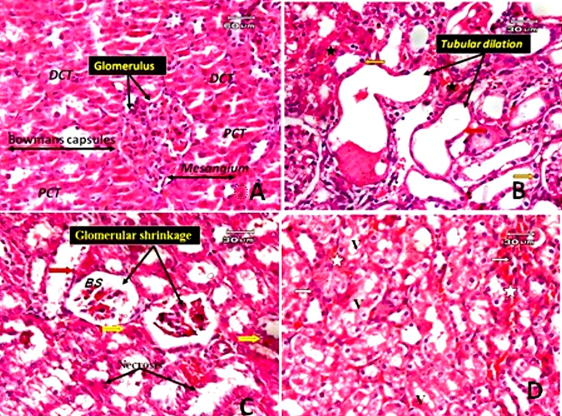 Photomicrographs of the rat kidney. A: Normal control shows proximal convoluted tubules (PCT), distal convoluted tubules (DCT), the renal corpuscle consists of Bowman's capsule and glomerular capillaries, mesangium. B: The kidney section of a rat treated with TAA only showing extensive tubular dilatation, epithelial flattening (red arrow), hemorrhage in interstitial tissue (star) and pyknotic cells (orange arrow). C: kidney section of rat treated with TAA only (another filed) showing glomerular shrinkage with wide urinary space of Bowman's capsule (BS), cloudy swelling of some tubular epithelium (yellow arrow), signs of degeneration in the form of necrosis (black arrow) and desquamation of some cells (red arrow). D: a kidney section from a rat treated only with TAA (another file from that of C) demonstrating vacuoles in renal tubular epithelial cells (v) and hemorrhage in interstitial tissue (star) (E&H).