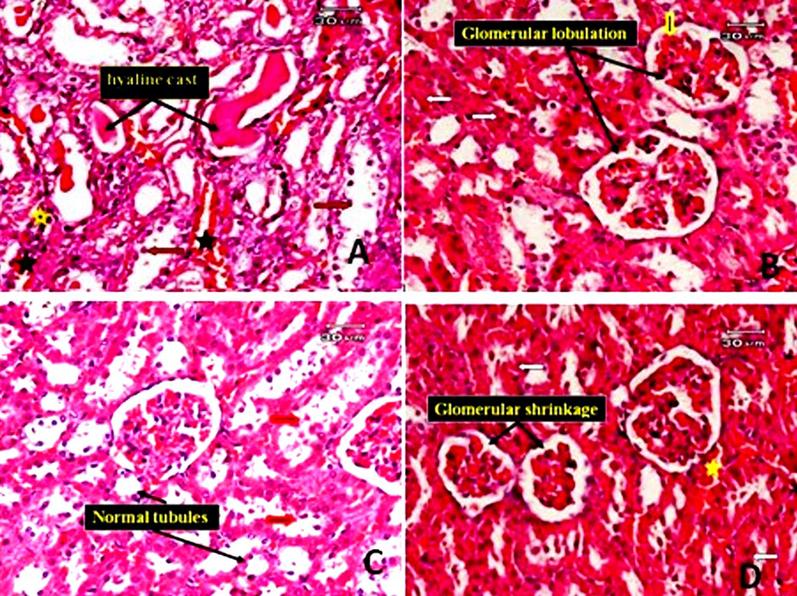 Photomicrographs of the rat kidney. A: The kidney tissue of rats treated with TAA and subjected to gallic acid at a dose level of 100 mg/kg (low dose), showed no improvement in pathological changes. The kidney tissue showed hyaline casts (black arrow) present in the modularly of some tubules, desquamation in tubular epithelial cells (red arrow), some degenerated tubules, a few inflammatory infiltrates (yellow star) and hemorrhage in interstitial tissue (black star). B: the kidney section of a rat treated with TAA and subjected to gallic acid at a low dose (another field) showed glomerular lobulation (black arrow), interglomerular hemorrhage (yellow arrow) and cloudy swelling of some renal tubules (white arrow). C: kidney section of rat treated with TAA and subjected to gallic acid at high dose showing some improvement in pathological changes in the form of no hylain cast with no dilatation of tubules, although cell debris in lumen of some tubules (red arrow), some normal tubule could be observed. D: kidney section of rat treated with TAA and subjected to gallic acid at high dose (another filed) showing glomerular shrinkage, cloudy swelling of some tubules (red arrow) and hemorrhage in interstitial tissue (star) (E&H).