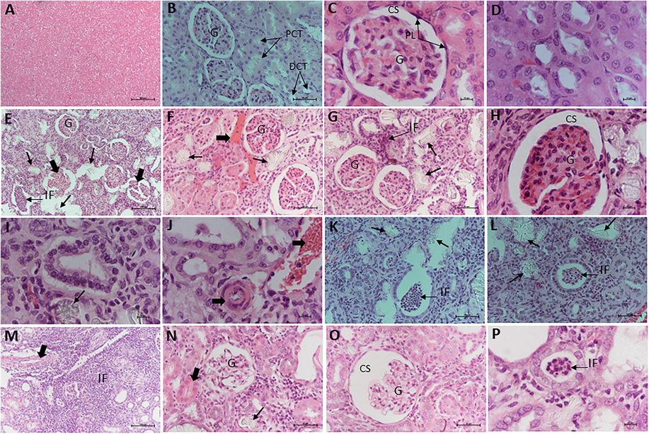 Histopathological alterations in rat offspring kidneys after exposure to allethrin compared to control. The photomicrographs of the cortex of the kidney of control group stained with H&E (A-D) show a large number of glomeruli (A), normal glomeruli structure (B-C), and normal proximal and distal convoluted tubules (D). (E-L) Photomicrographs of renal histology stained with H&E in the group treated with the low dose of allethrin 34.2 mg/kg. (E): Abnormal features in the kidney tissue including atrophy of glomeruli, (F) calcification (arrow) and fibrosis (large arrow), (G) inflammation (IF), calcification (arrow) and fibrosis. (H) the capsule space went a dilation whereas the glomerulus shrank. (I-L) The collecting ducts have also been affected as a large number of inflammatory cells (IF), calcification (arrow), and fibrosis (large arrow) have been largely observed. (M−P) Photomicrographs of renal histology stained with H&E in the group treated with the high dose of allethrin (68.5 mg/kg). There are still more damages including (M) high inflammation (N and O) shrining of the glomeruli and dilatation of the capsule space, and (P) tubular inflammation. (n = 8).