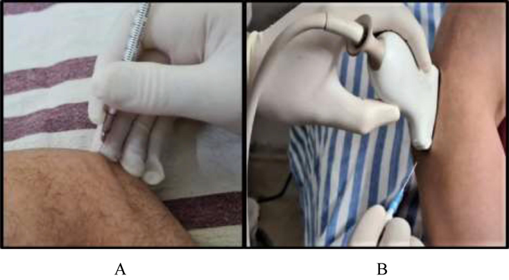 A. blind injection is carried out B. guided injection is being done.