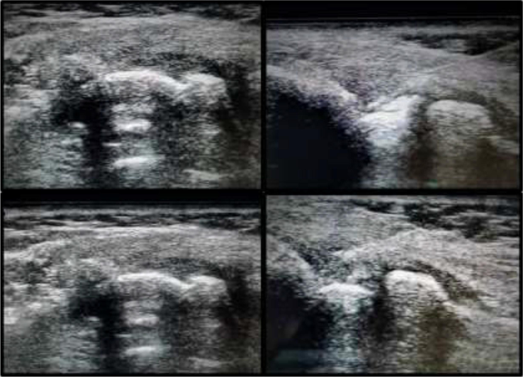 Depicting US-images of patient treated with local steroid injection: The images on the left side are prior to the injection while as those on the right side are while carrying out the procedure (NEEDLE CAN BE SEEN IN RIGHT IMAGES).