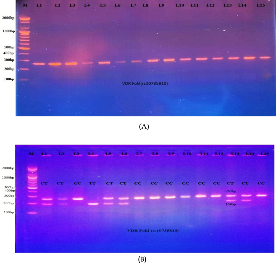 A: PCR product for the VDR gene (FokI, 265 bp). Fig. 1-B: PCR-RFLP analysis of FokI polymorphisms following digestion with FokI restriction enzymes. The 265 bp bands showed wild homozygote C/C. Both the 96 and 169 bp bands showed mutant homozygote T/T. The 265, 96, and 169 bp bands indicated the presence of heterozygote C/T.