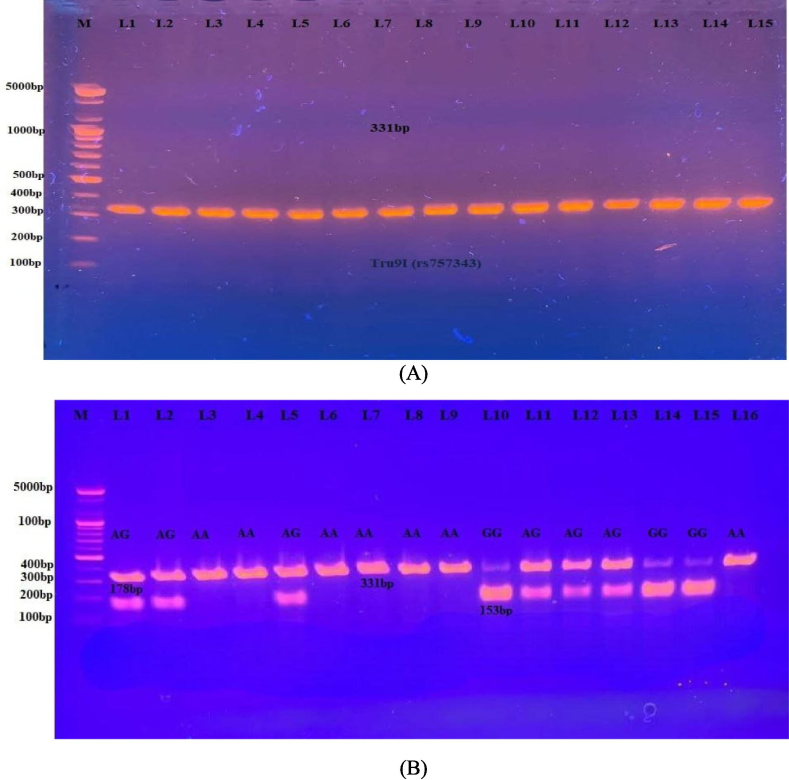 A PCR results for the VDR gene (Tru9I, 331base pair). Fig. 3-B: Electrophoretogram of DNA segment for Tru9I variation after digestion with MesI. Homozygous wild A/A was present as a 331 bp. The homozygote mutant (G/G) was present at 178 and 153 bp. A heterozygous A/G was present as the 331, 178, and 153 bp.