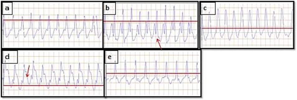 Effect of C.tomentosa on ISO 85 mg/kg induced changes of ECG parameters in rats. Images of (a) Normal control (b) ISO control, (c), Metoprolol (10 mg/kg), (d) C.tomentosa (200 mg/kg) treated (e) C.Tometosa (400 mg/kg) treated treated rats. The red arrow represents ST elevation in rats treated with ISO. (For interpretation of the references to colour in this figure legend, the reader is referred to the web version of this article.)