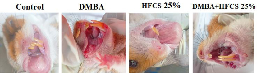 Photograph showing the gross appearance of oral tumors. Buccal pouch mucosa of experimental and control animals (n = 6): gross appearance. Group 2&4 Exophytic well-defined tumor mass in the hamster’s buccal pouch at 12 weeks after being painted with DMBA and DMBA + HFCS (25 %). Group 1 control &3HFCS (25 %)alone have shown the normal buccal pouch.