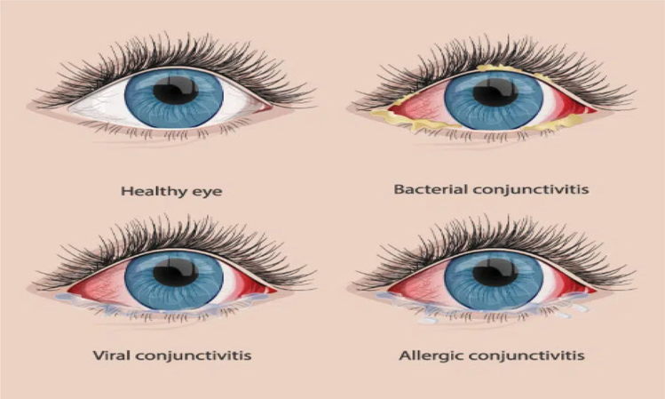 Conjunctivitis (Pink Eye) symptoms.