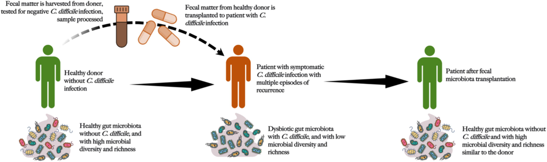 Schematic representation of the process of fecal microbiota transplantation.