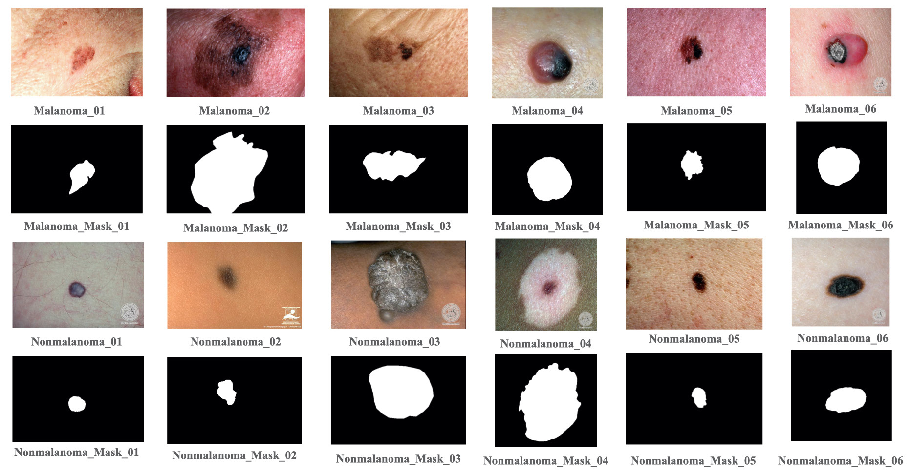 Some images and each image’s mask of melanoma and nonmelanoma data sample of DermIS and DermQuest Dataset. DermIS: Dermatology image search, DermQuest: Dermatology quest.