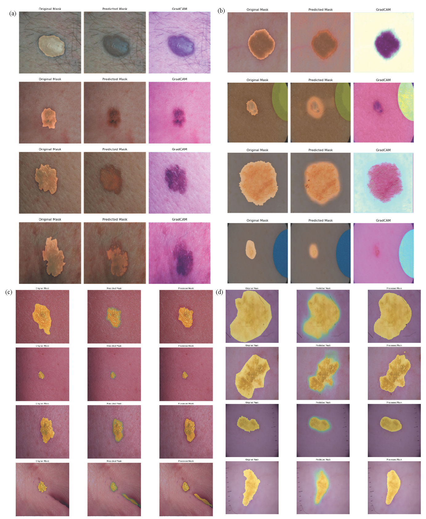 Grad-CAM visual explanations of predicted data samples, highlighting the model’s focus areas for skin cancer classification. (a) Illustrates results on our customized DermIS and DermQuest datasets, while (b) Showcases predictions on the ISIC (2016) dataset. (c) and (d) Compare the original, predicted, and processed masks for melanoma and nonmelanoma classifications. Specifically, (c) Visualizes these masks for the DermIS and DermQuest datasets, whereas (d) Focuses on melanoma predictions within the ISIC (2016) dataset. These visualizations provide insights into model interpretability and segmentation accuracy. Grad-CAM: Gradient-weighted Class Activation Mapping, DermIS: Dermatology Image Search, DermQuest: Dermatology Quest, ISIC (2016): International Skin Imaging Collaboration (2016).